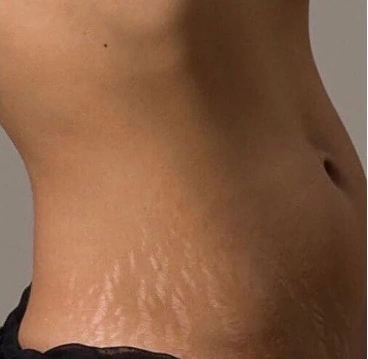 Stretch Marks (Per Body Part) image