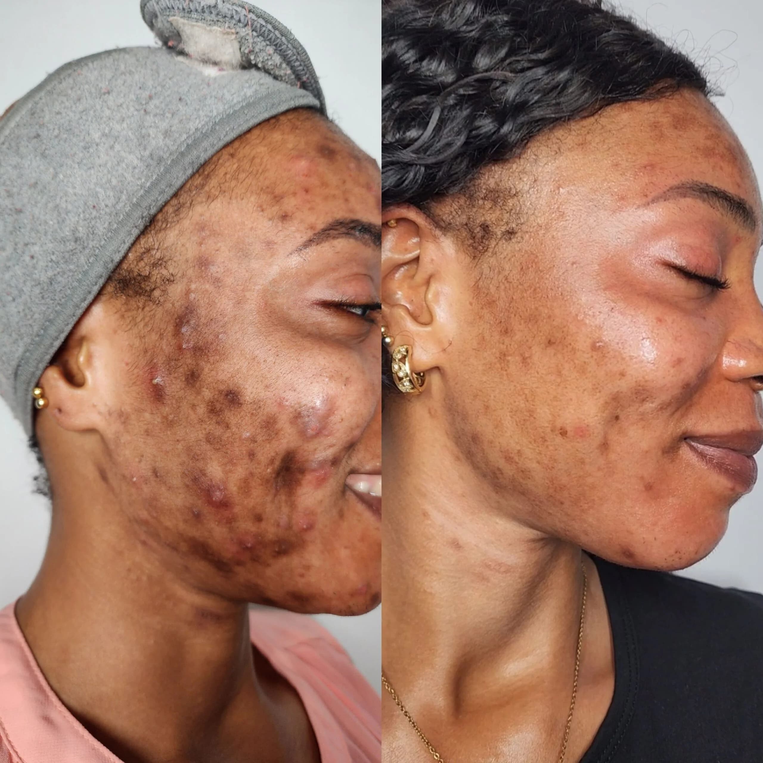 Acne Corrective Peel image