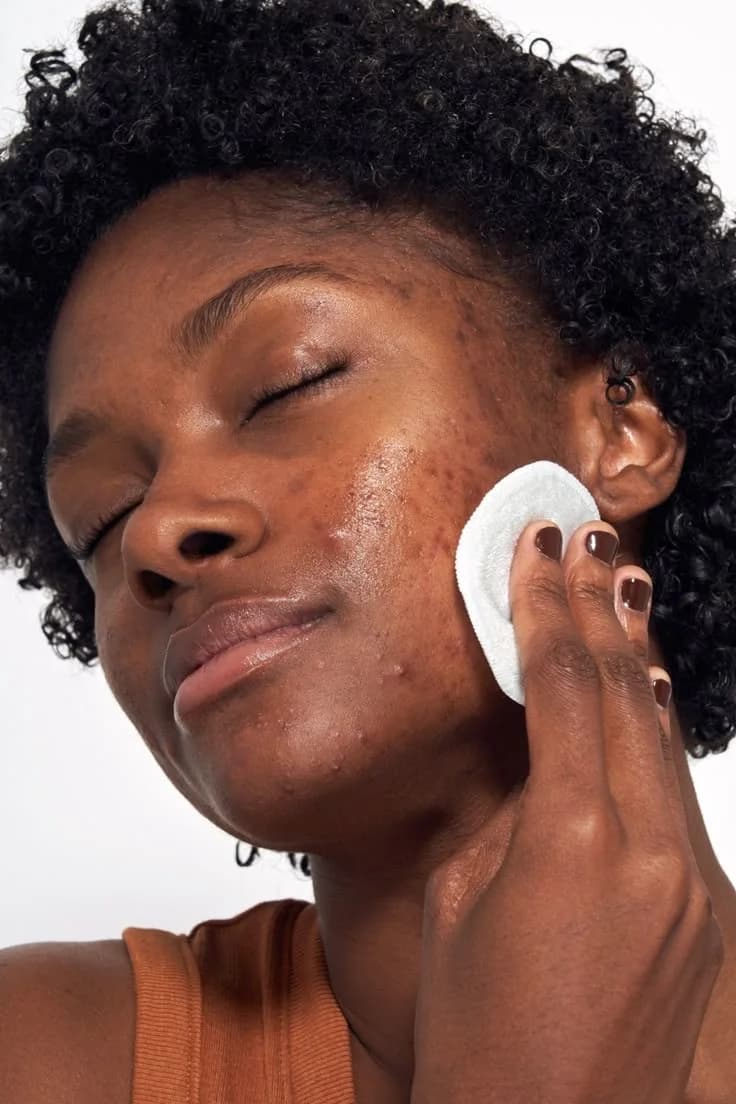 Acne Corrective Facial image