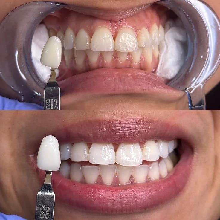 Teeth Whitening